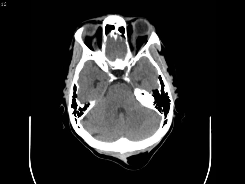 File:Atypical meningioma - intraosseous (Radiopaedia 64915-73867 A 16).jpg