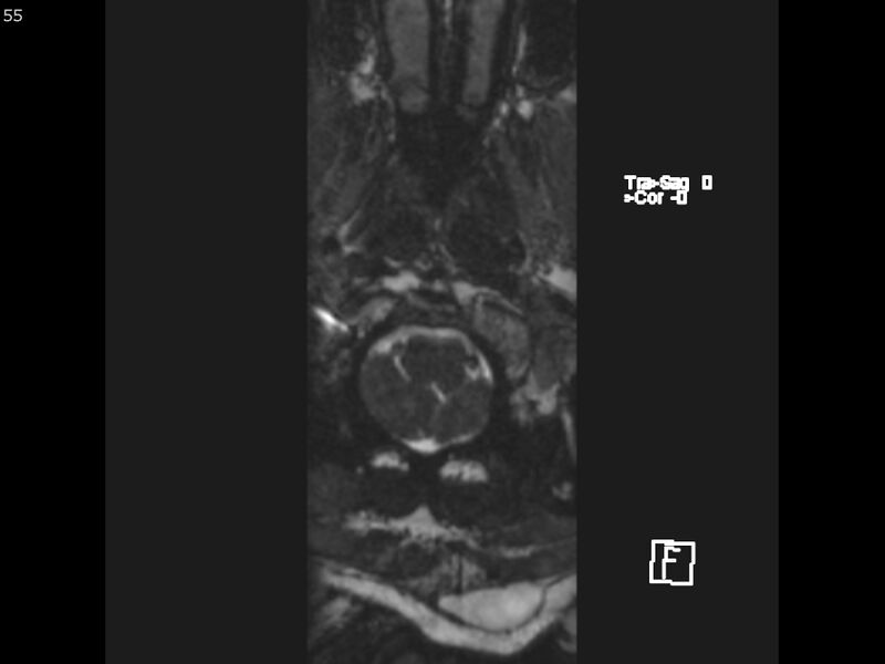 File:Atypical meningioma - intraosseous (Radiopaedia 64915-74572 Axial CISS 55).jpg