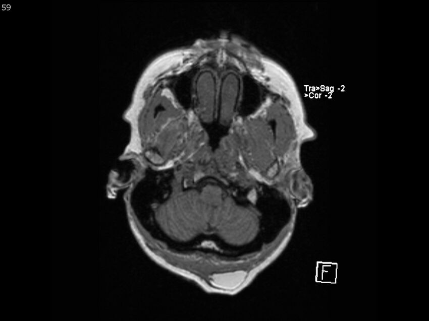 Atypical meningioma - intraosseous (Radiopaedia 64915-74572 Axial T1 59).jpg