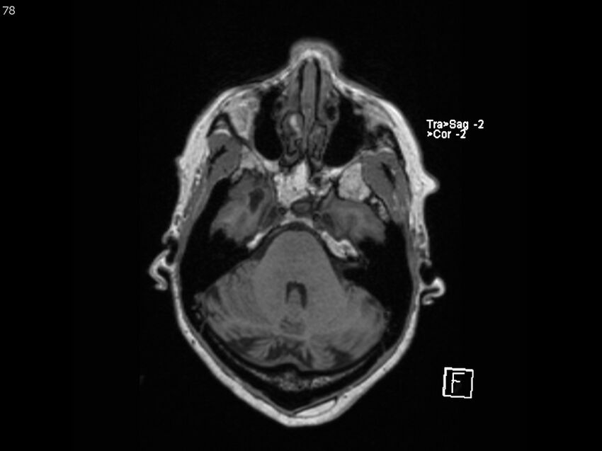Atypical meningioma - intraosseous (Radiopaedia 64915-74572 Axial T1 78).jpg