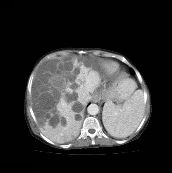 File:Autosomal dominant polycystic kidney disease (Radiopaedia 16777-16490 A 11).jpg