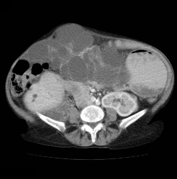 File:Autosomal dominant polycystic kidney disease (Radiopaedia 16777-16490 A 35).jpg