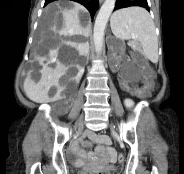 File:Autosomal dominant polycystic kidney disease (Radiopaedia 16777-16490 B 30).jpg