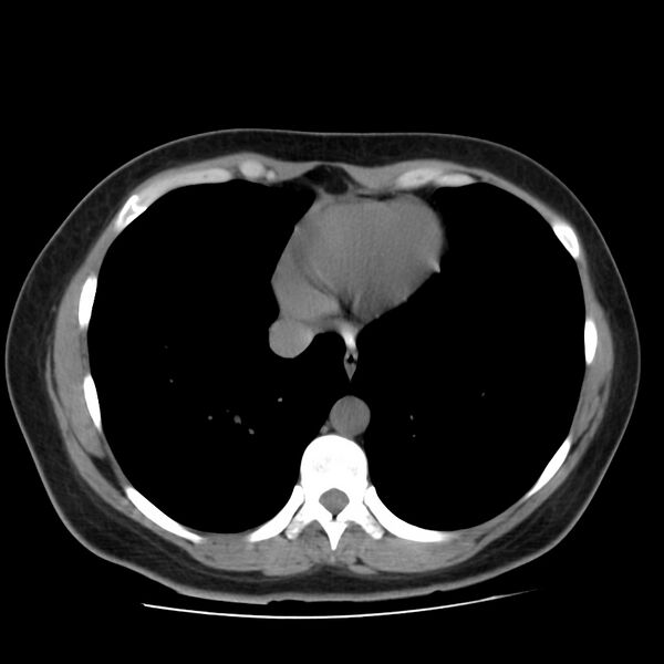 File:Autosomal dominant polycystic kidney disease (Radiopaedia 23061-23093 Axial non-contrast 1).jpg
