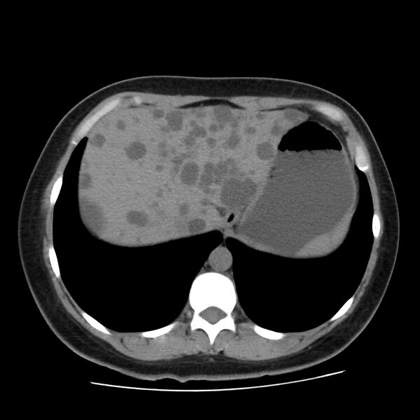 File:Autosomal dominant polycystic kidney disease (Radiopaedia 23061-23093 Axial non-contrast 9).jpg