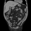 Autosomal dominant polycystic kidney disease (Radiopaedia 36539-38101 C 23).jpg