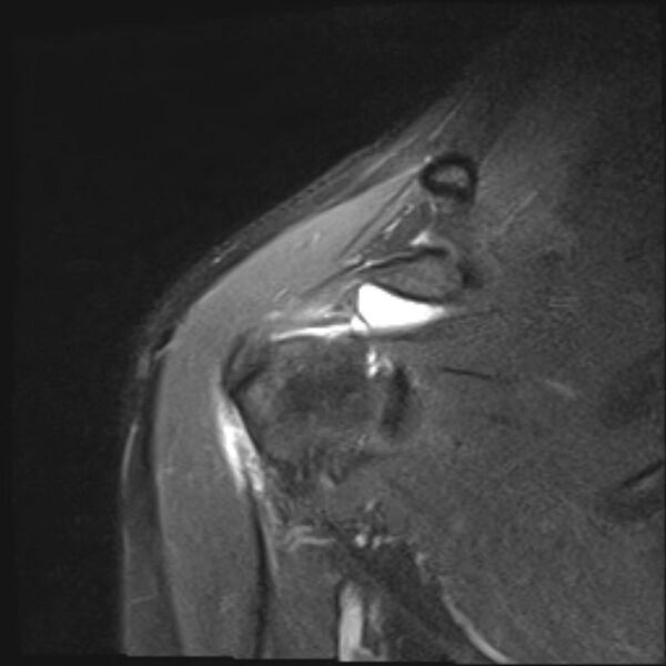 File:Avulsion fracture - greater tuberosity of humerus (Radiopaedia 71216-81515 Coronal PD fat sat 14).jpg