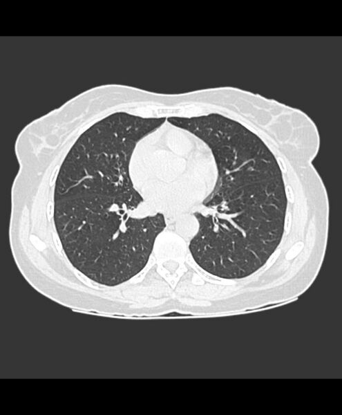File:Azygos fissure and azygos lobe (Radiopaedia 41841-44832 Axial lung window 10).jpg