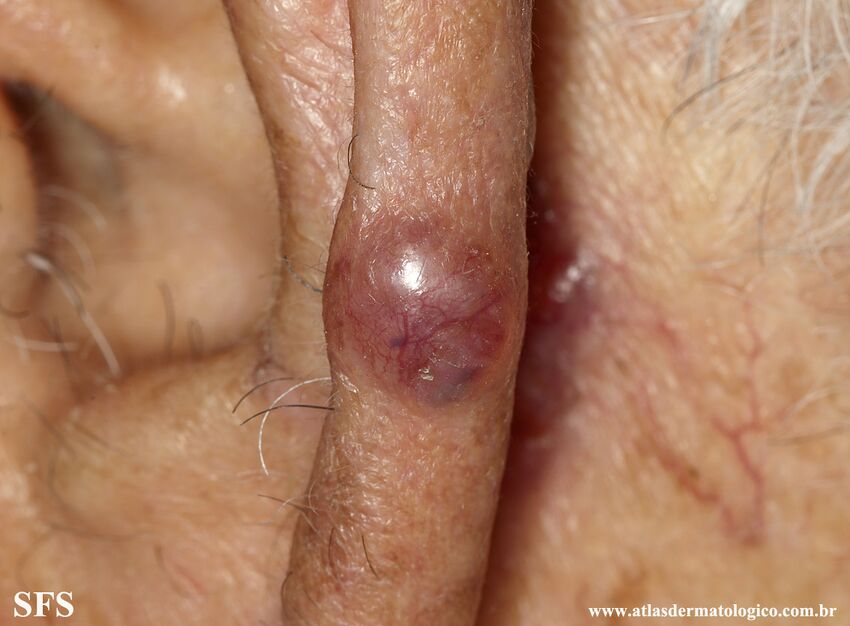 Basal Cell Carcinoma (Dermatology Atlas 281).jpg