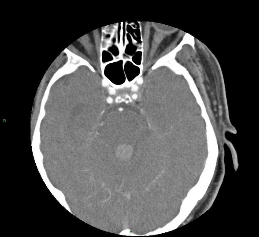 Basal ganglia hemorrhage (Radiopaedia 58763-65985 D 65).jpg