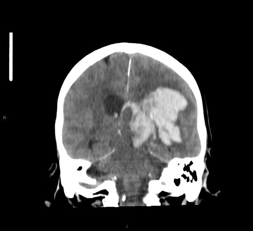 Basal ganglia hemorrhage (Radiopaedia 58767-65989 Coronal non-contrast 31).jpg