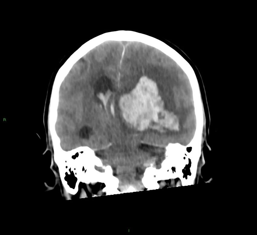 Basal ganglia hemorrhage (Radiopaedia 58775-66008 Coronal non-contrast 30).jpg