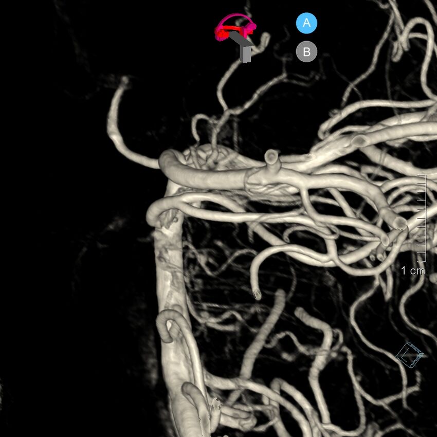 Basilar artery perforator aneurysm (Radiopaedia 82455-97734 3D view left VA 178).jpg