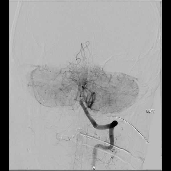 File:Basilar tip thrombus with endovascular clot retrieval (Radiopaedia 46320-50726 B 14).png