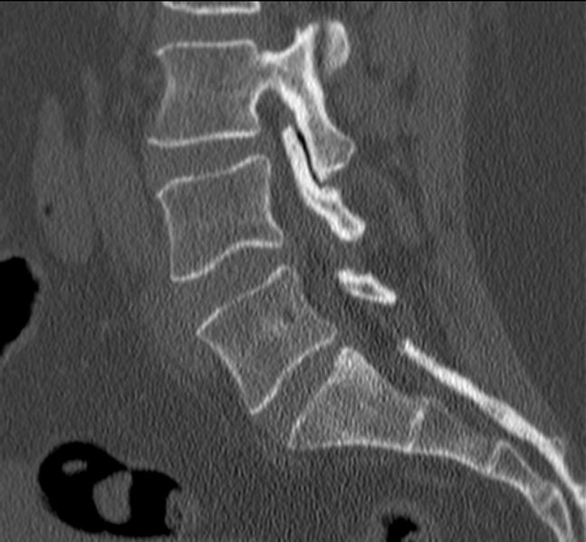 File:Bertolotti syndrome (Radiopaedia 24864-25128 Sagittal bone window 33).jpg