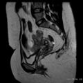 Bicornuate uterus- on MRI (Radiopaedia 49206-54297 Sagittal T2 16).jpg