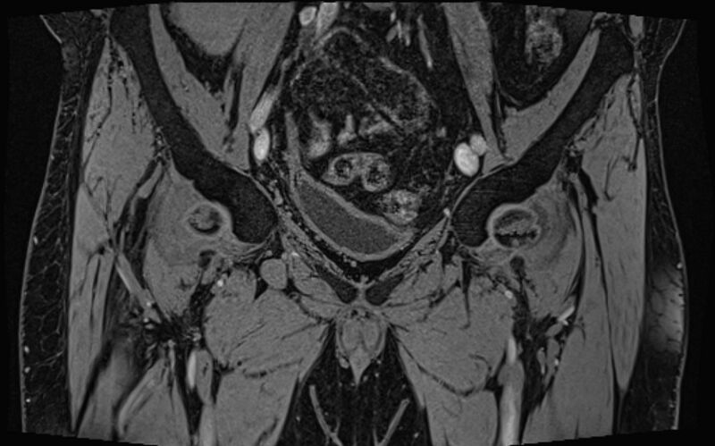 File:Bilateral avascular necrosis of femoral head (Radiopaedia 77116-89078 Coronal T2 we 71).jpg