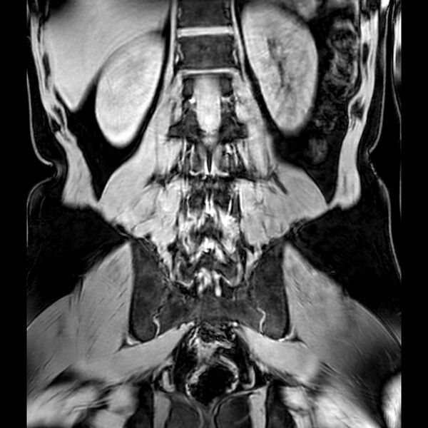 File:Bilateral conjoined nerve roots at different levels (Radiopaedia 73312-84063 Coronal WE 37).jpg