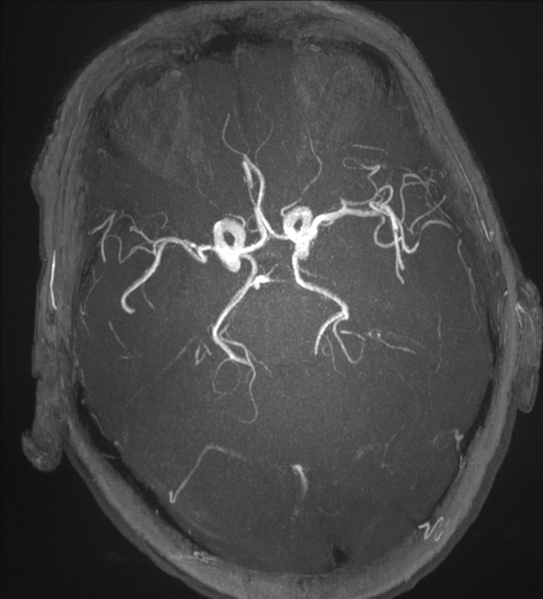 File:Bilateral fetal posterior communicating arteries (Radiopaedia 41286-44102 Axial Thick MIP 1).png
