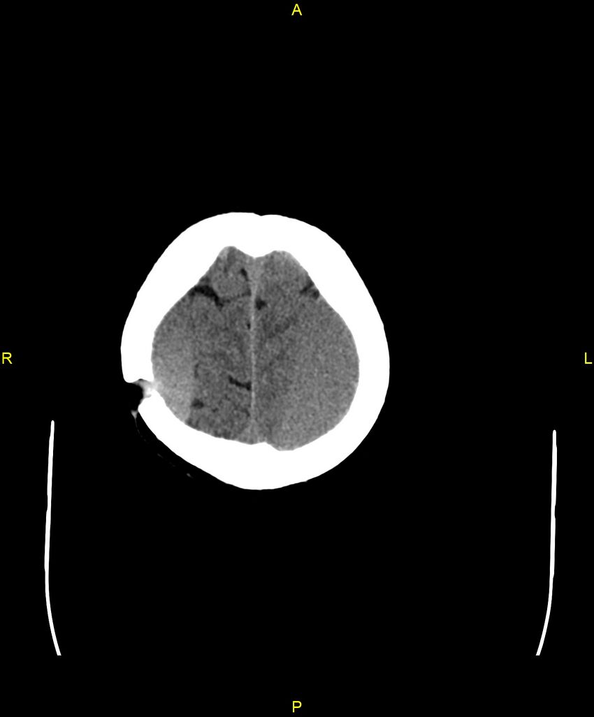 Bilateral isodense subdural hematomas (Radiopaedia 88621-105325 Axial non-contrast 97).jpg