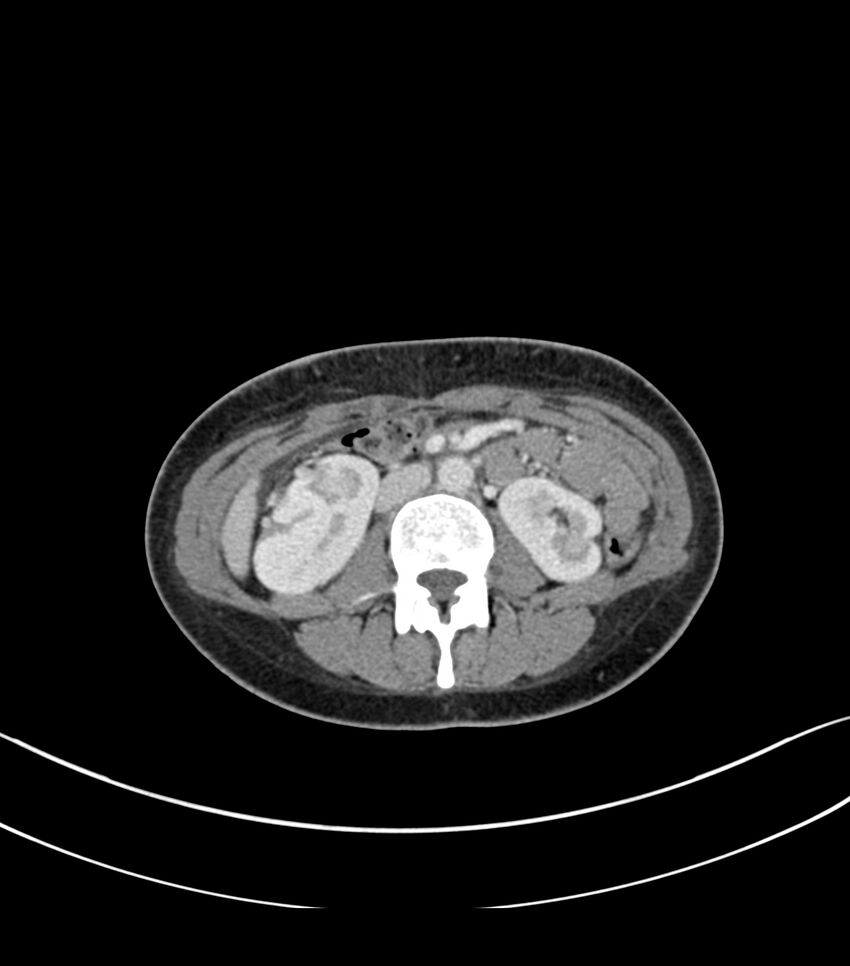 Bilateral kidney malrotation (Radiopaedia 72227-82749 A 27).jpg