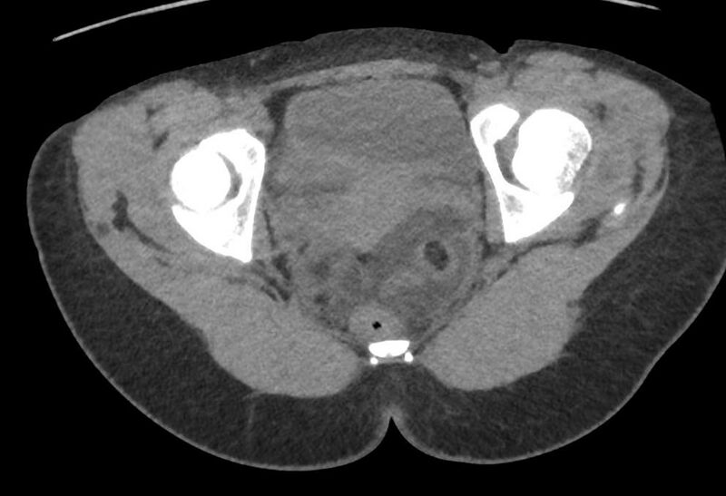 File:Bilateral mature cystic ovarian teratoma (Radiopaedia 88821-105592 Axial non-contrast 40).jpg