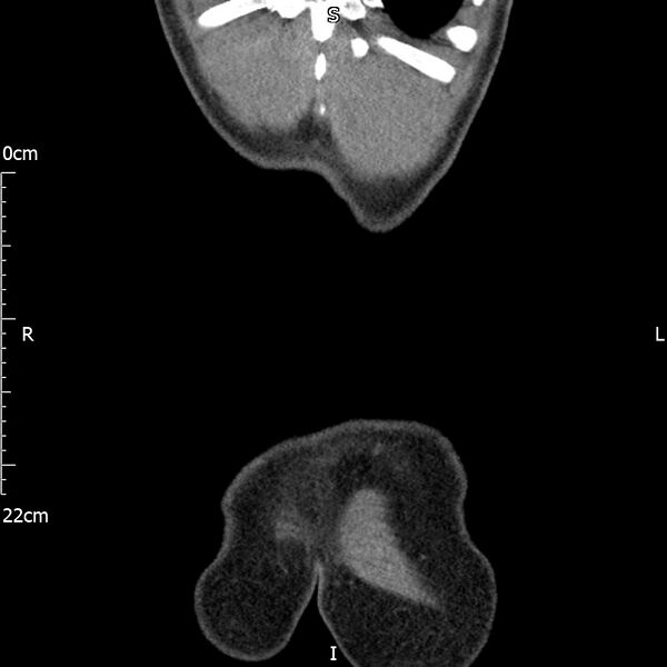 File:Bilateral medullary nephrocalcinosis with ureteric calculi (Radiopaedia 71269-81569 Coronal non-contrast 74).jpg
