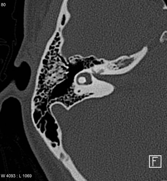 File:Bilateral otosclerosis with left stapes prosthesis (Radiopaedia 5567-7302 Axial bone window 13).jpg