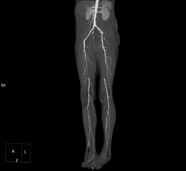 File:Bilateral superficial femoral arterial occlusion (Radiopaedia 25682-25857 3D MIP 24).jpg