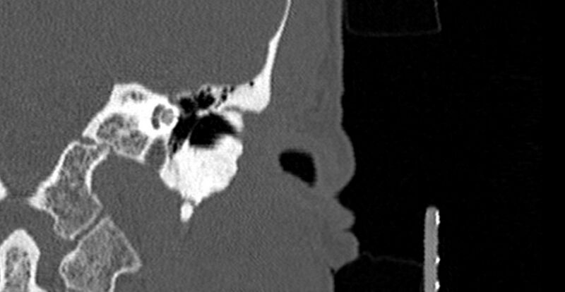 File:Bilateral temporal bone fractures (Radiopaedia 29482-29970 B 16).jpg
