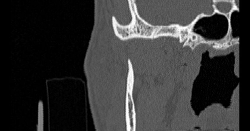 Bilateral temporal bone fractures (Radiopaedia 29482-29970 Coronal non-contrast 5).jpg