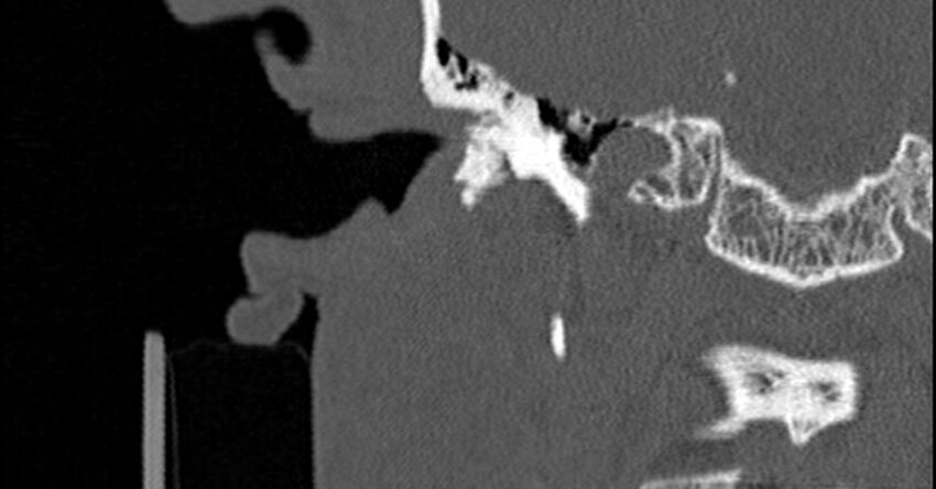 Bilateral temporal bone fractures (Radiopaedia 29482-29970 Coronal non-contrast 80).jpg