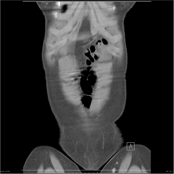 File:Bilateral ureteritis and cystitis (Radiopaedia 25340-25594 B 6).jpg