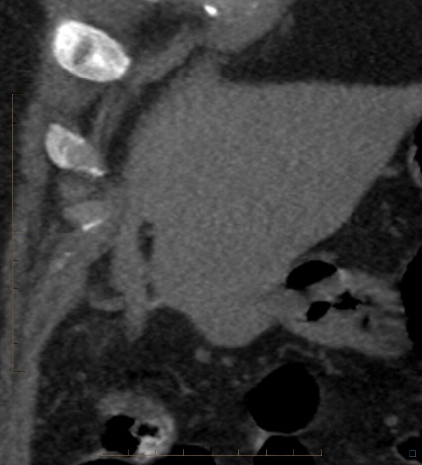 Bile leak from accessory duct(s) of Luschka post cholecystectomy (Radiopaedia 40736-43389 B 13).jpg