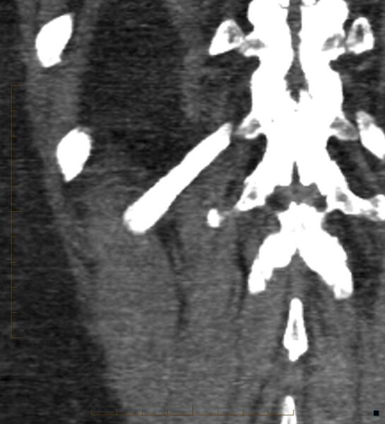 File:Bile leak from accessory duct(s) of Luschka post cholecystectomy (Radiopaedia 40736-43389 B 68).jpg