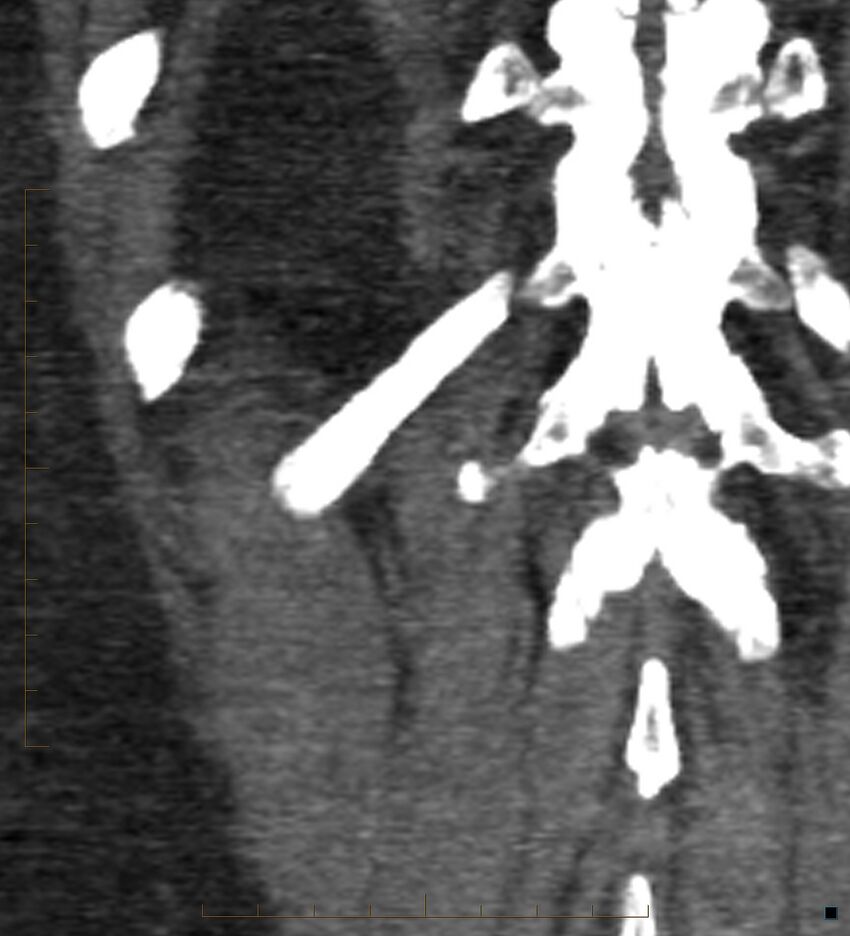 Bile leak from accessory duct(s) of Luschka post cholecystectomy (Radiopaedia 40736-43389 B 68).jpg