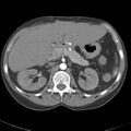 Biliary necrosis - liver transplant (Radiopaedia 21876-21845 A 21).jpg