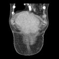 Biliary necrosis - liver transplant (Radiopaedia 21876-21846 C 2).jpg