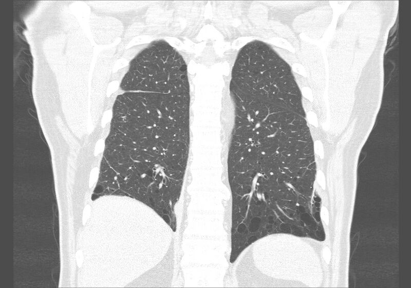File:Birt-Hogg-Dubé syndrome (Radiopaedia 52578-58491 Coronal lung window 48).jpg