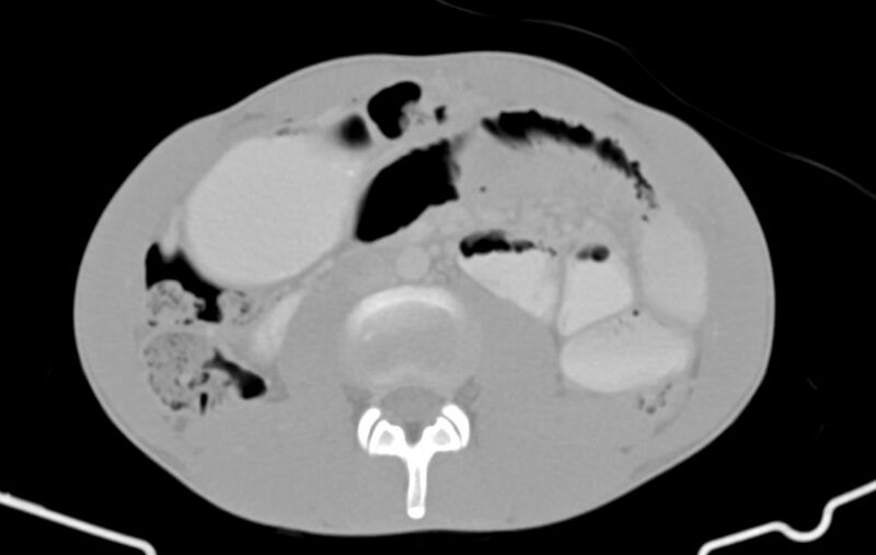 File:Blunt injury to the small bowel (Radiopaedia 74953-85987 Axial Wide 46).jpg