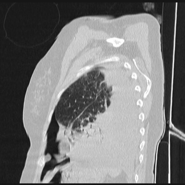 File:Boerhaave syndrome (Radiopaedia 45644-49799 Sagittal lung window 70).jpg
