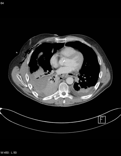 File:Boerhaave syndrome with tension pneumothorax (Radiopaedia 56794-63605 A 31).jpg