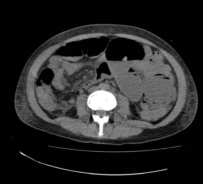 File:Bowel lymphoma complicated by bleeding after therapy (Radiopaedia 55601-62110 Axial non-contrast 45).jpg