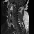 Brachial plexopathy (Radiopaedia 21844-21806 Sagittal T1 C+ 4).jpg