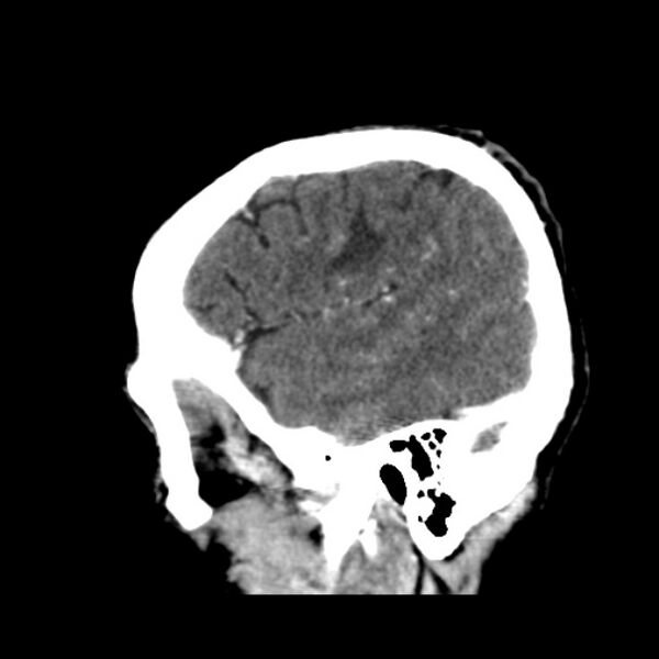 File:Brain metastases from lung cancer (Radiopaedia 24480-24781 C+ delayed 11).jpg