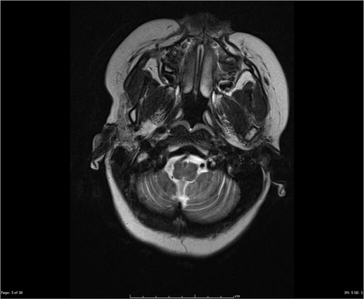 File:Brainstem glioma (Radiopaedia 21819-21775 Axial T2 5).jpg