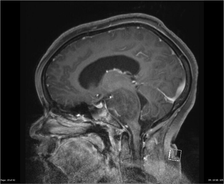 File:Brainstem glioma (Radiopaedia 21819-21775 D 19).jpg