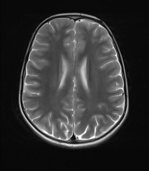 File:Brainstem glioma (Radiopaedia 70548-80674 Axial T2 17).jpg