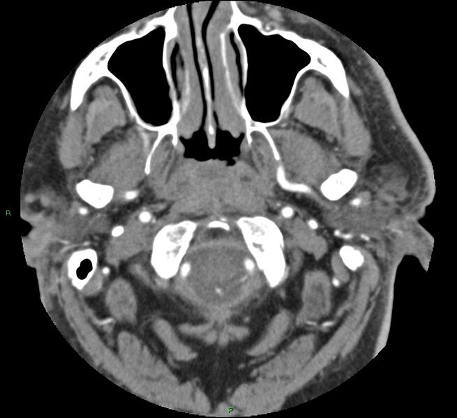 File:Brainstem hemorrhage (Radiopaedia 58794-66028 D 15).jpg