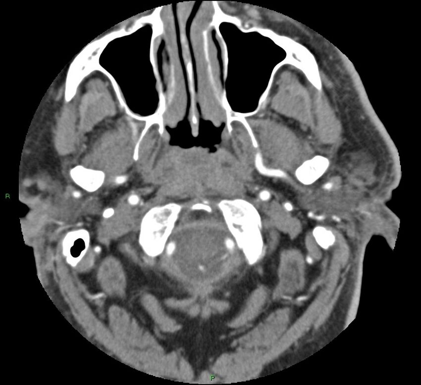Brainstem hemorrhage (Radiopaedia 58794-66028 D 15).jpg